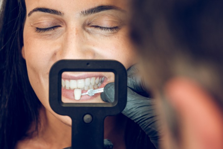 What Are Porcelain Veneers_ Benefits, Process & Smile Advantages