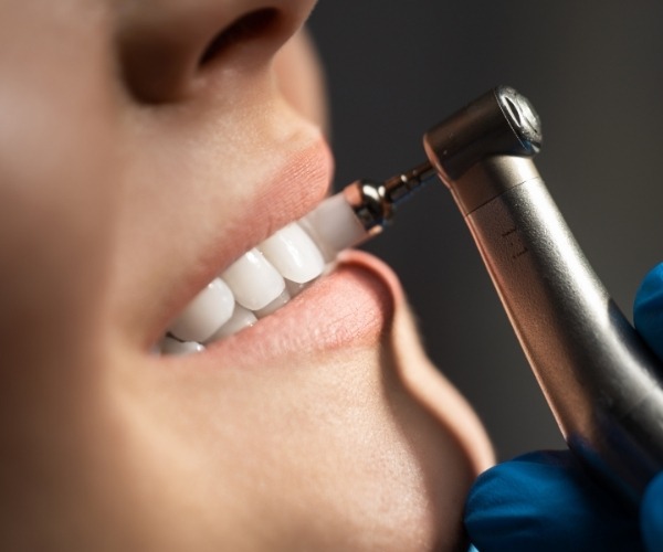 Dental Cleaning in Brampton