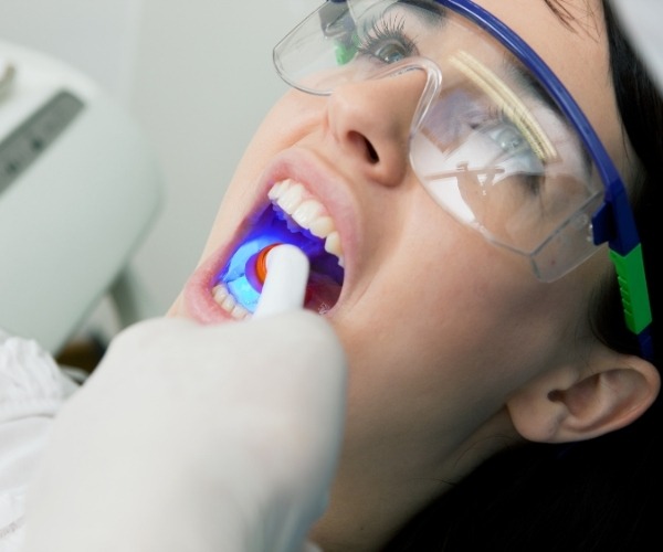Dental Fillings in Brampton