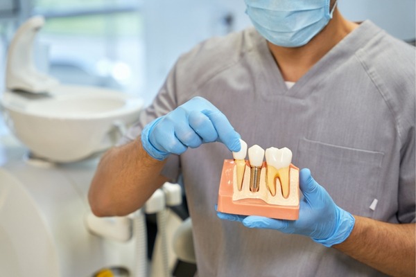 Dental Implants in Brampton