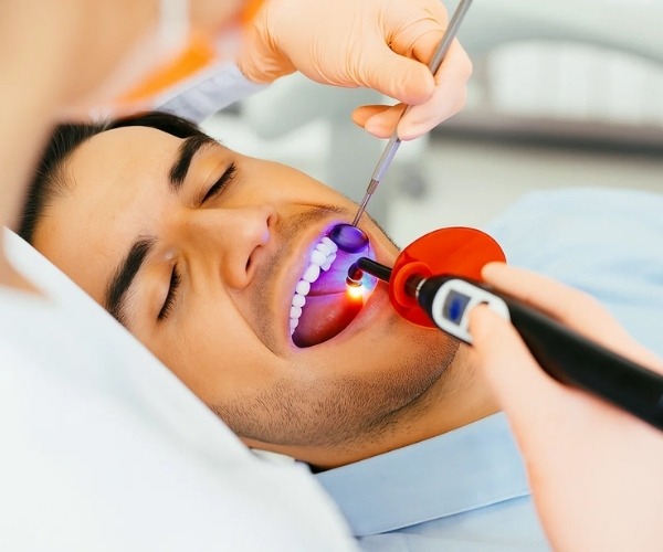 Dental Sealants in Brampton
