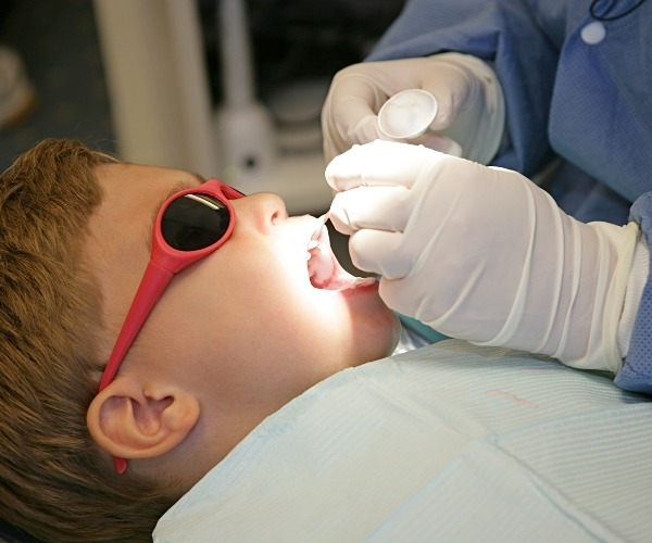 Fluoride Treatment in Brampton