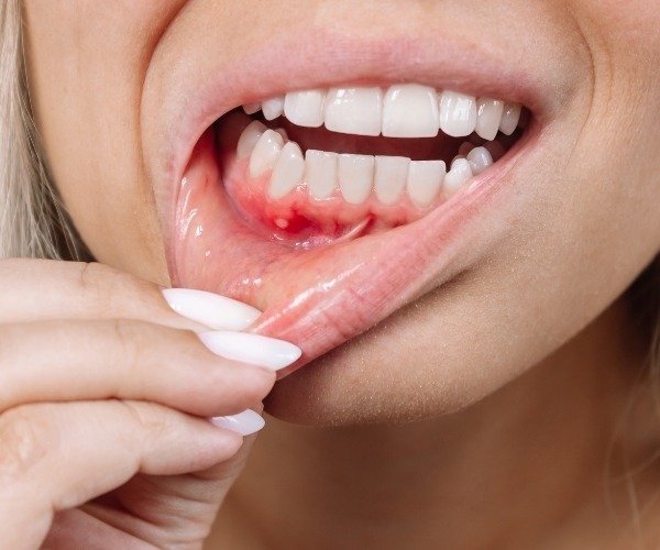 Gum Disease Treatment Brampton