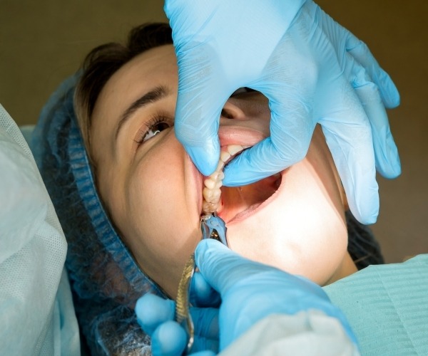 Tooth Extraction in Brampton