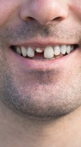 A cracked or fractured tooth