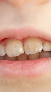 A discoloured or misshapen tooth