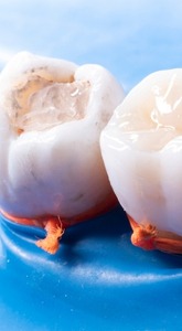 A large filling or broken filling