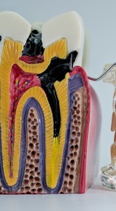 A tooth treated with root canal therapy