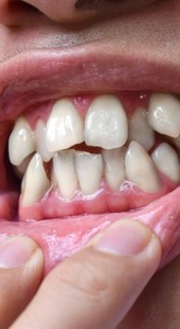 Bite problems caused by uneven teeth
