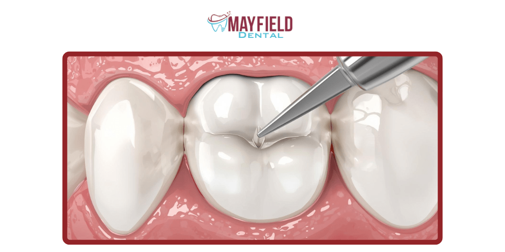 Composite Resin Fillings (White Fillings)