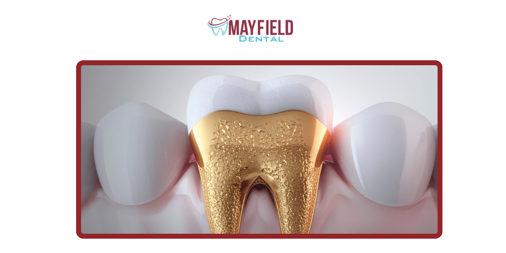 Gold Fillings (Less Common Today)