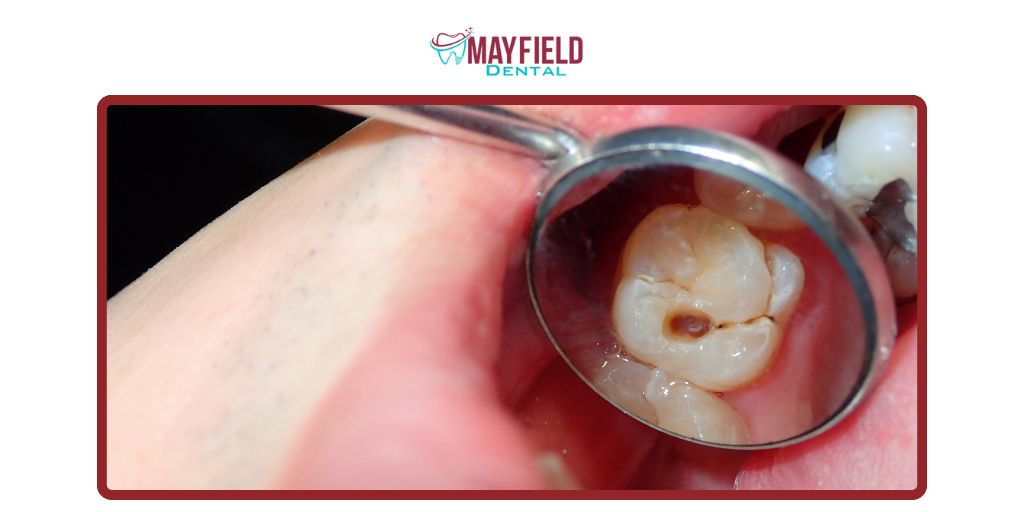 What Is a Dental Cavity