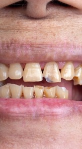 Worn enamel or grinding damage