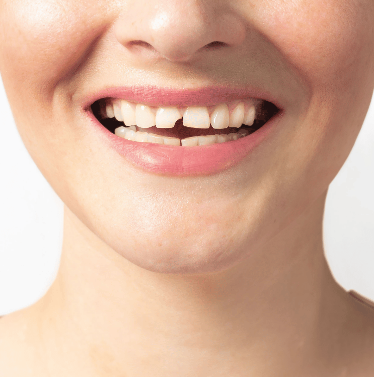 Broken or Chipped Tooth Repair brampton
