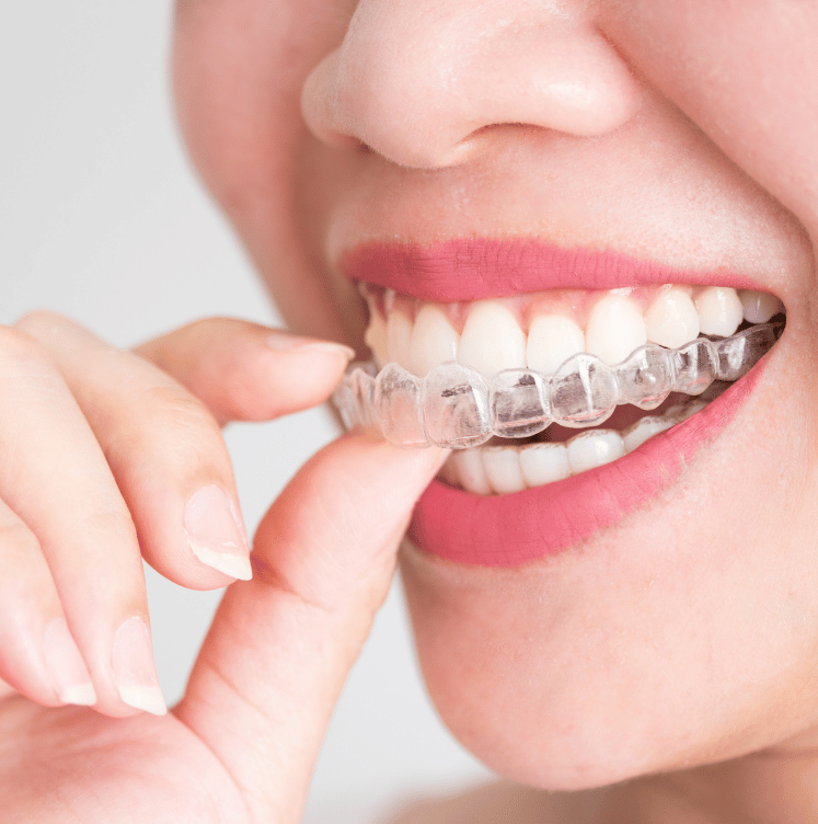 Invisalign for adults