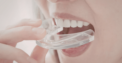 Night Guards for Teeth Grinding - mayfield dental