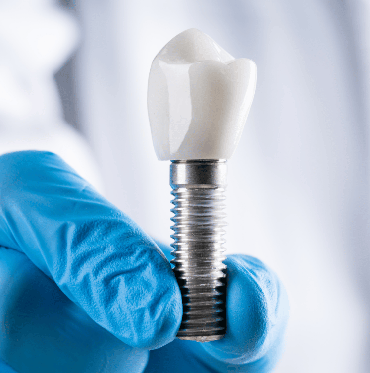 Single Tooth Implants brampton ontario