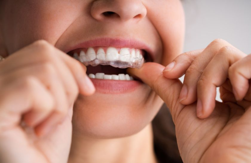 Invisalign for Adults in Brampton
