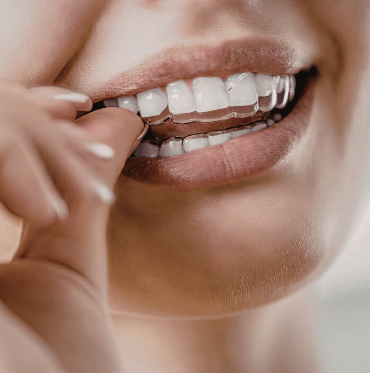 clear aligners brampton ontario