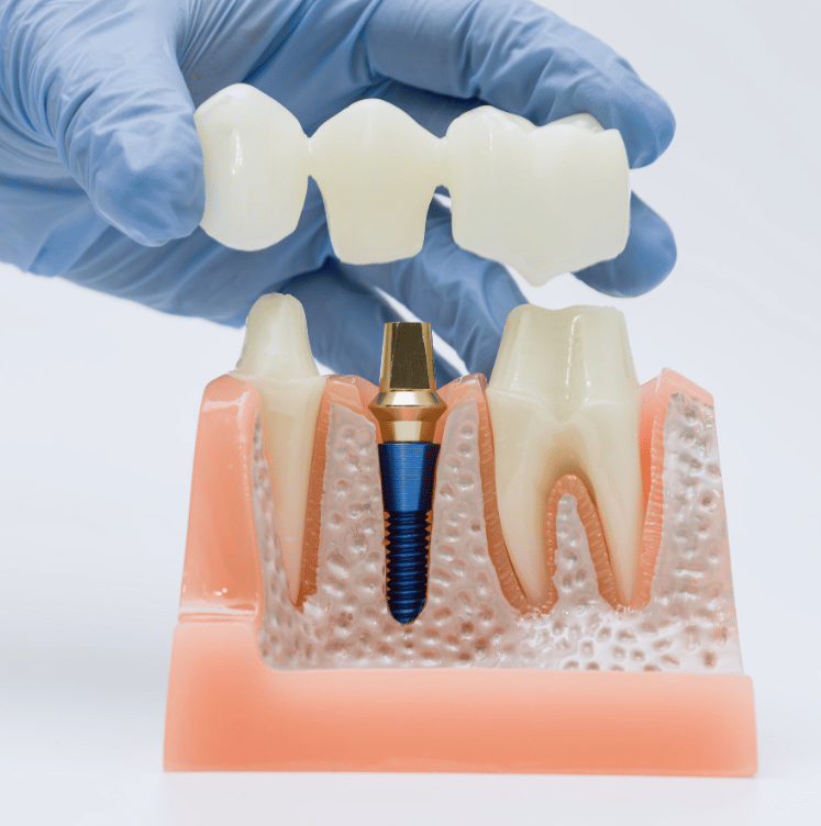 dental bridge brampton ontario