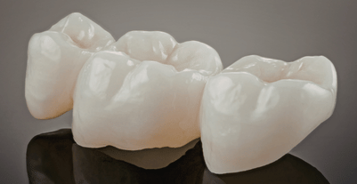dental crown replacement - emergeny dentistry brampton