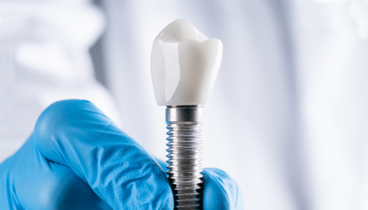 dental implants brampton