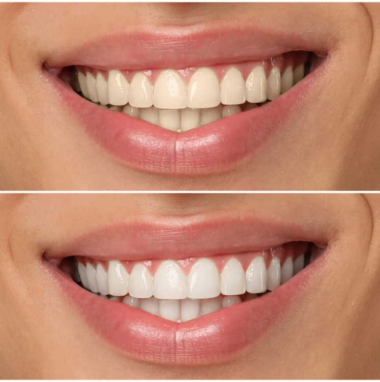 teeth whitening professional