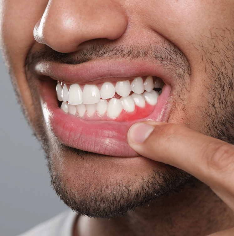 gum disease and symptoms
